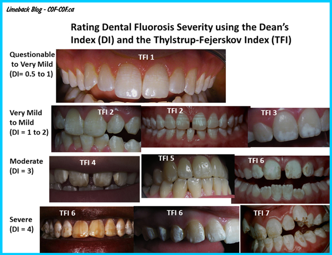 Rating-Dental-Fluorosis-Limeback-Blog-COC-COF1